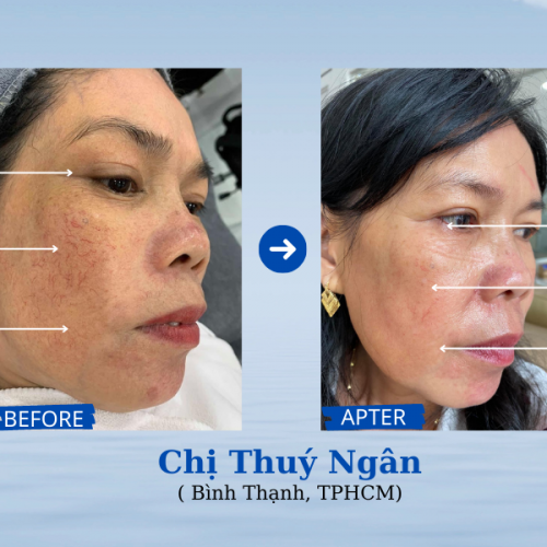 Nếp nhăn da chùng xạm2